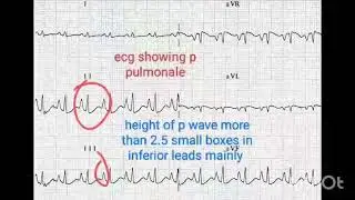 ECG changes in copd patient 