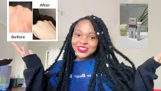 My skin journey *how I cured my eczema with photo evidence before and after* South African YouTuber