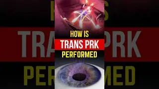 How Is Trans PRK Surgery Performed I Live Trans PRK Surgery