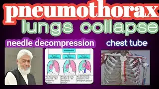 WHAT IS PNEUMOTHORAX. WHAT IS COLLAPSE LUNGS. WHAT IS NEEDLE DECOMPRESSION. WHAT IS CHEST TUBE.