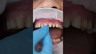 Veneers replacement in action! #Shorts #dentalveneers