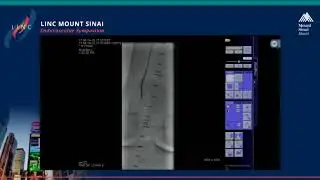 Live Case Presentation #13 ANTEGRADE APPROACH FOR TREATMENT OF CRITICAL LIMB ISCHEMIA