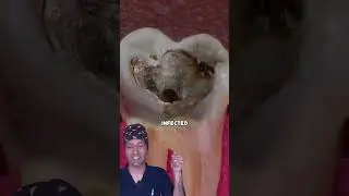 Amazing Dentist Explains Root Canal #satisfying