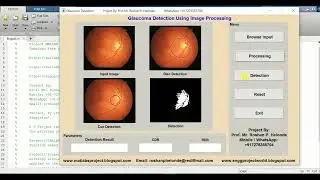 Glaucoma Classification Using Matlab Project With Source Code | Glaucoma Detection Image Processing