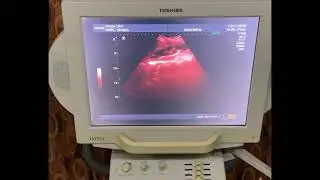 Renal Cortical Thinning - Ultrasound