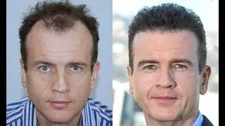 Who should perform a hair transplant in Los Angeles?