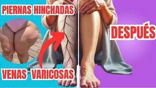 SE TE  HINCHAN LAS PIERNAS, VENAS VARICOSAS Y TIENES DOLOR Y PESADEZ a partir DE LOS 40, HAS &Eacute;STO!.