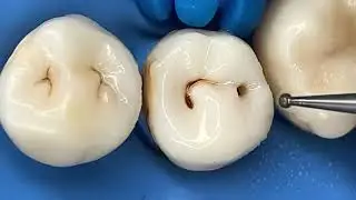 Repairing Cavities by Drilling out the Tooth and filling the space