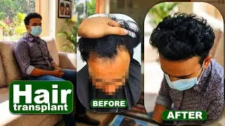 Hair transplant in indore | Best Results & Cost of Hair Transplant in indore