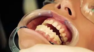 FirstFit Veneers