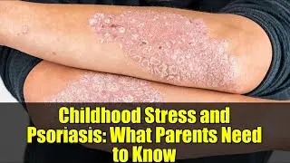 Childhood Stress and Psoriasis: What Parents Need to Know | New Study Explained