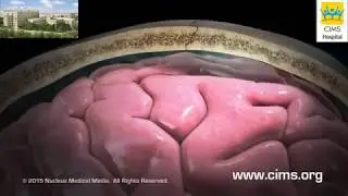 Concussion  (Hindi) - CIMS Hospital