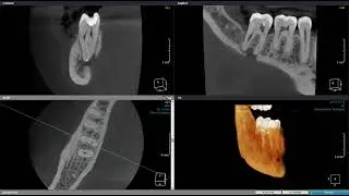 Instrumento fraturado devido à curvatura oculta dos canais mesiais de um 47