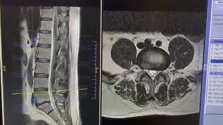 Spine labeling Axial slice #viralvideo #anatomy #CT scan#medicalimaging #science