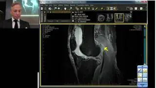 Where Did the Meniscus go? Meniscocapsular Separation Case