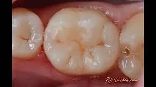 Лечение кариеса зуба 4.6
