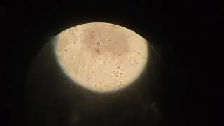 RBC (Red blood cells)  in urine. | Under microscope ||