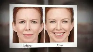 A Collection of Botox Before & After Photos