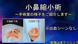 【小鼻縮小術直後、患者さんの感想】@山本クリニック