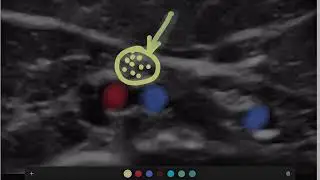 Patient - How to hold probe lift compression.mp4