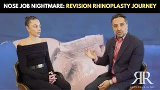 NOSE JOB NIGHTMARE: Revision Rhinoplasty Journey 💔👃 #plasticsurgery