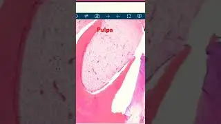 Gotitas 💦 💦 de Odontoma #oralpathology #oralpath #odontomas