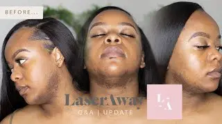 FACIAL HAIR REMOVAL Q&A, UPDATE + LASER AWAY REVIEW | Just Grvce