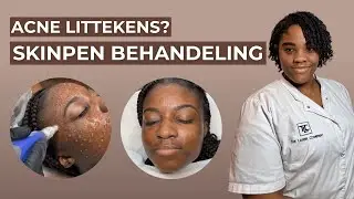 SkinPen Huidbehandeling Donkere Huid | Acne Hyperpigmentatie | The Laser Company