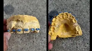 RETAINER LIKE BRACES WITH GUMS