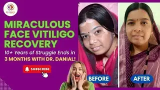 Miraculous Face Vitiligo Recovery | 15+ Years of Struggle Ends in 3 Months with Dr. Danial