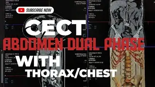 🔝HOW TO DO CECT ABDOMEN DUAL/DOUBLE PHASE WITH THORAX/CHEST||PROCESS, PROTOCOLS AND POSITIONS||⁉️