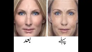 How To Remove Wrinkles From Face And Forehead Naturally In Urdu/Hindi