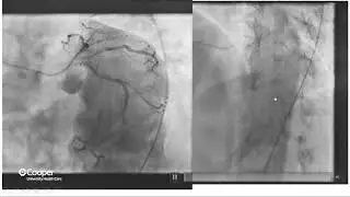 Cardiology Case Conference | 76 y/o Male WIth Chest Pain | Carine Basmadjian, MD