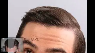 Hair Transplant Surgery by Dr. Baubac Hayatdavoudi of Alvi Armani
