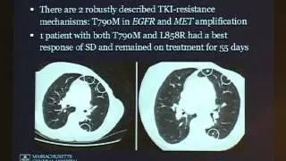 Targeted Therapy for Lung Cancer