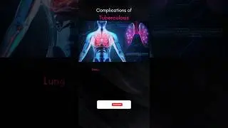 Complications of TUBERCULOSIS 💯❤️💪‼️ #health #life #science #shorts