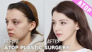 3 Surgeries in ONE DAY! Rhinoplasty and More at ATOP Plastic Surgery Korea