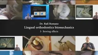 Dr. Rafi Romano-Lingual orthodontics biomechanics   3- bowing effects