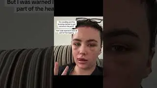 Hairline Lowering Surgery Journey - Beth Halsey