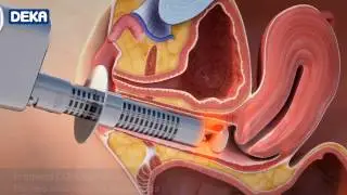 MonaLisaCarolina.com | New Laser Treatment Against Vaginal Atrophy, Laxity, and Urinary Incontinence