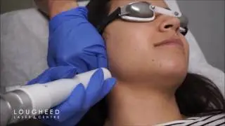 Laser Hair Removal With the Softlight Laser
