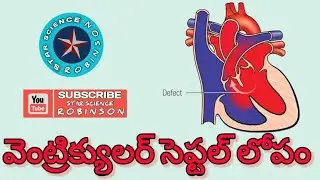 #VENTRICULAR SEPTAL DEFECT # IN TELUGU STARSCIENCE ROBINSON