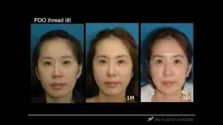 Korean Thread Lift & Nose Filler Before & After Surgery Pictures From JW Plastic Surgery