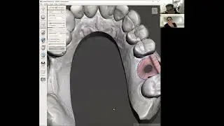 Digital extraction of a maxillary molar meshmixer software for immediate implant placement