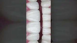 Teeth Turkey 🦷 Getting Veneers in Turkey | Is it worth? #teethturkey #veneersturkey
