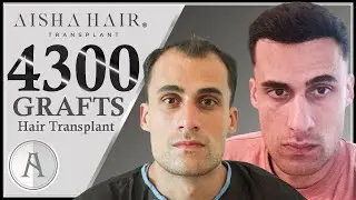 FUE Hair Transplant Time Lapse |4300 GRAFTS| Lapso de Tiempo de Injerto Capilar FUE |4300 FOLÍCULOS