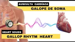 AUSCULTA DE GALOPE DE SOMA - Gallop Rhythm  Heart Auscultation