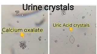 Crystals in urine sample | Calcium oxalate dihydrate and Uric Acid 