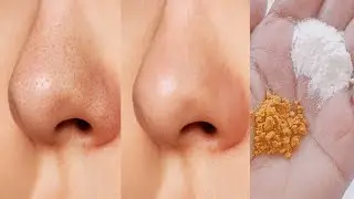 Remove blackheads from nose | Blackheads and whiteheads removal mask | Blackheads removal cream