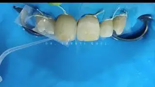 TREATMENT OF WHITE SPOT LESIONS DUE TO FLUOROSIS WITH RESIN INFILTRATION BY DR  SHRUTI GOEL